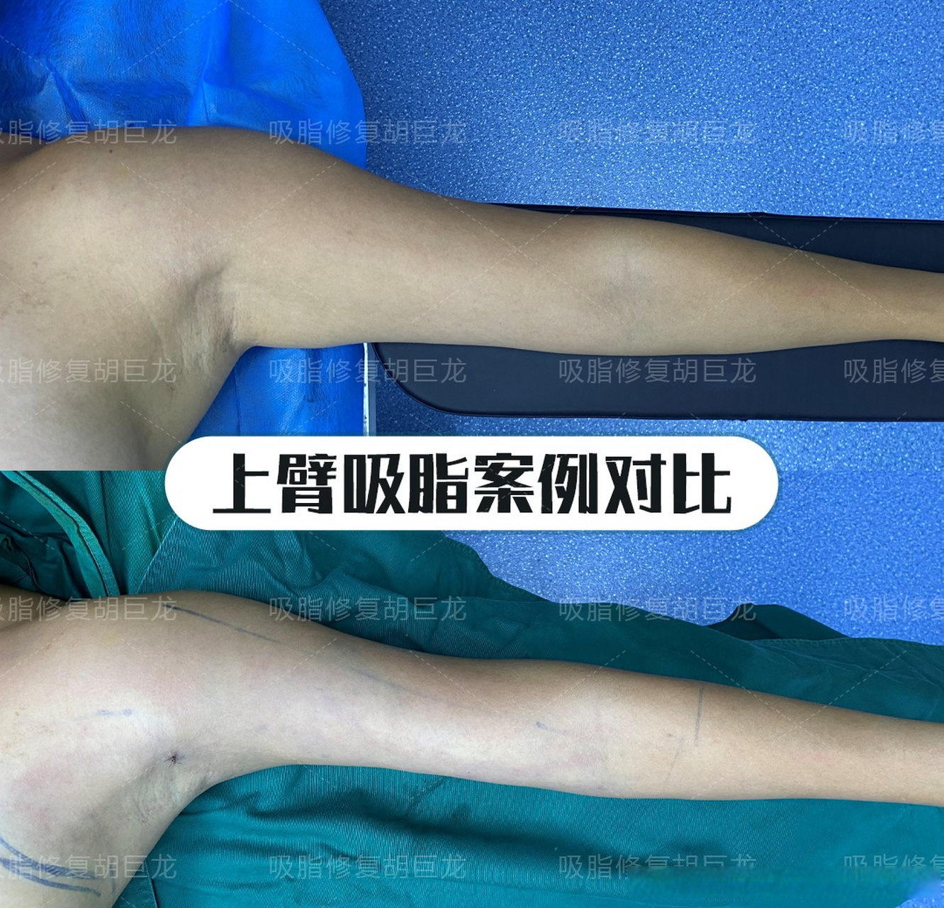 宝丽太手臂吸脂,副乳术后即刻对比案例  夏天快来了