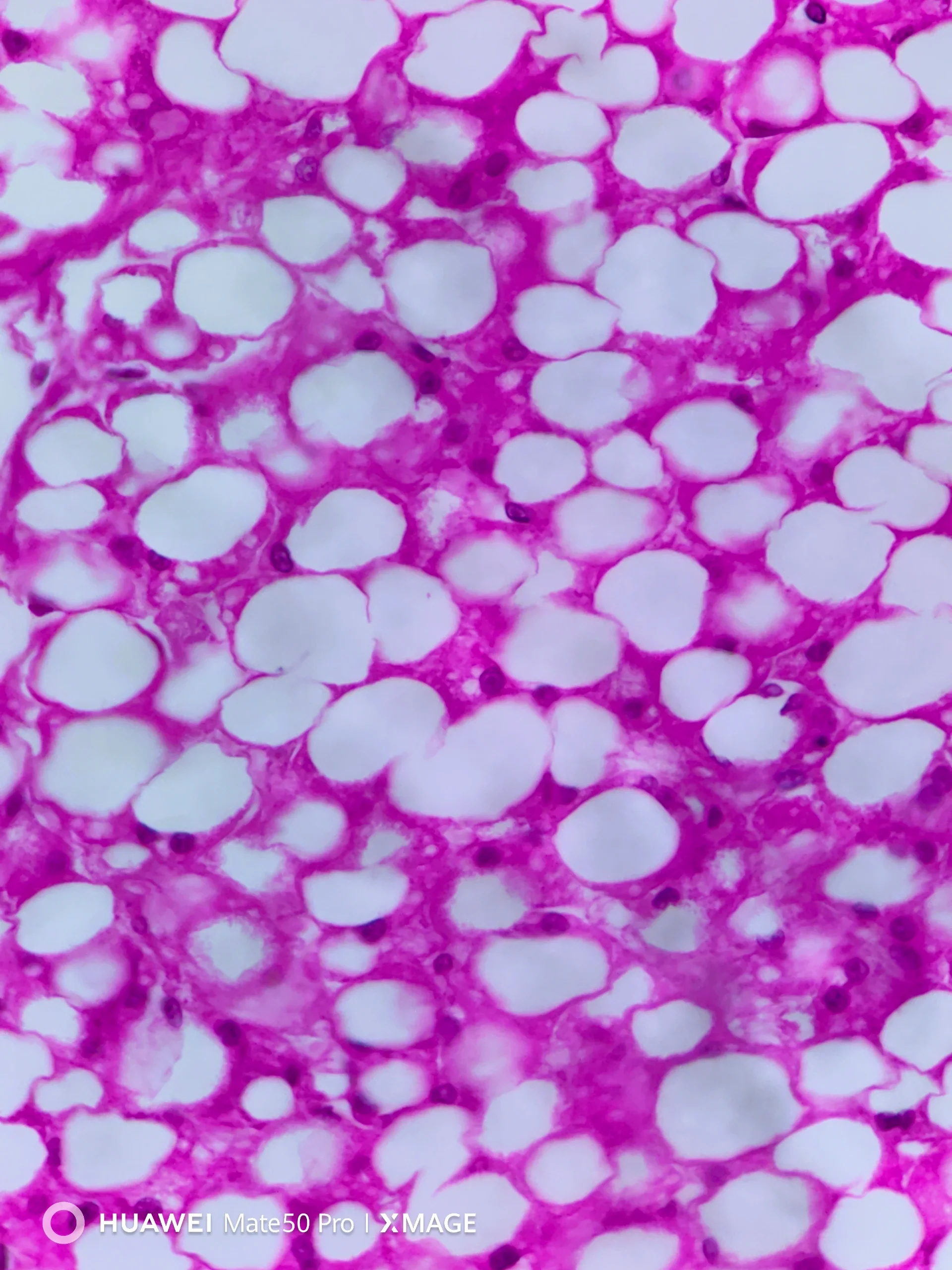 病理学-脂肪变性