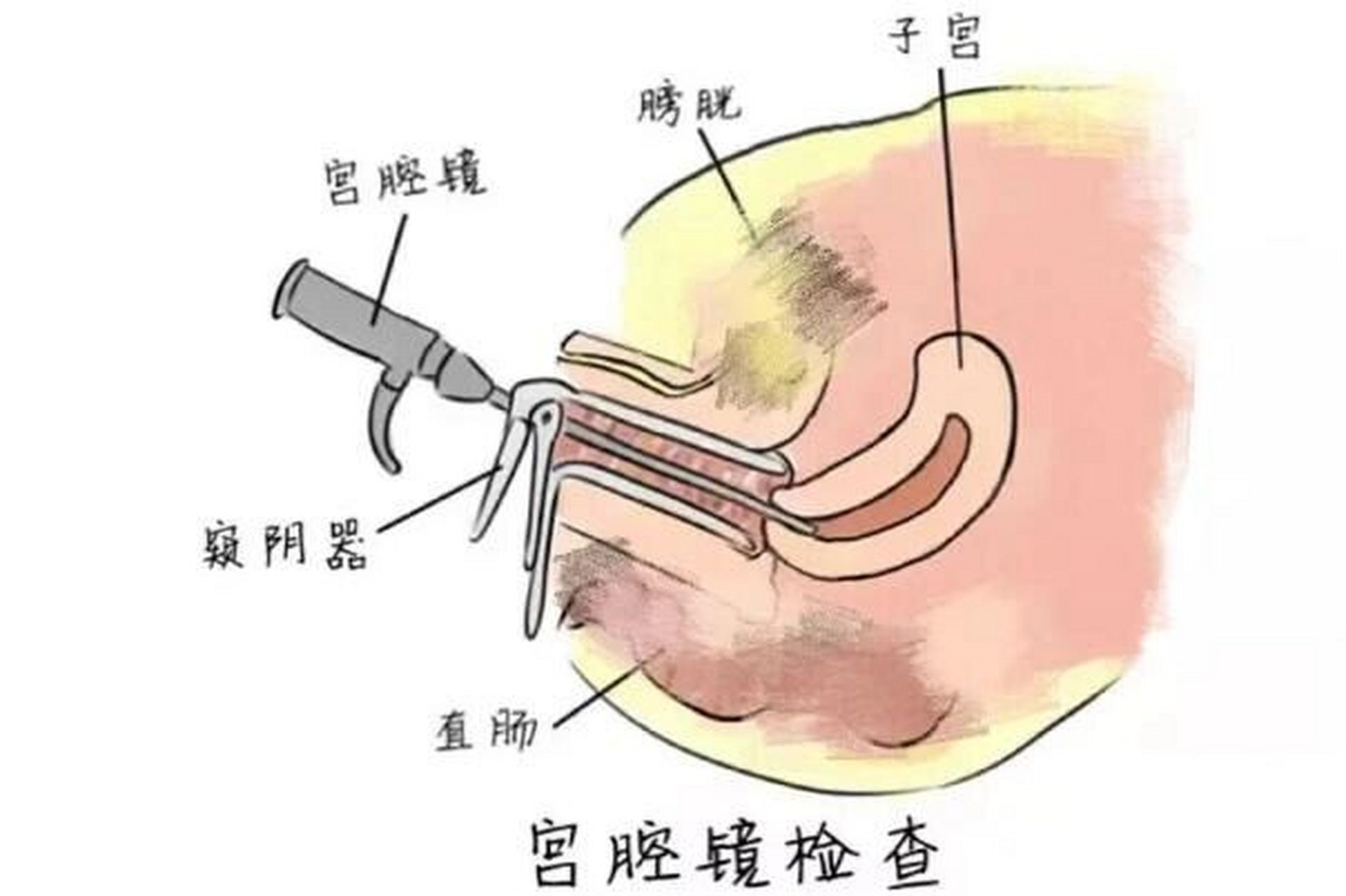 子宫纵隔图片宫腔镜图片