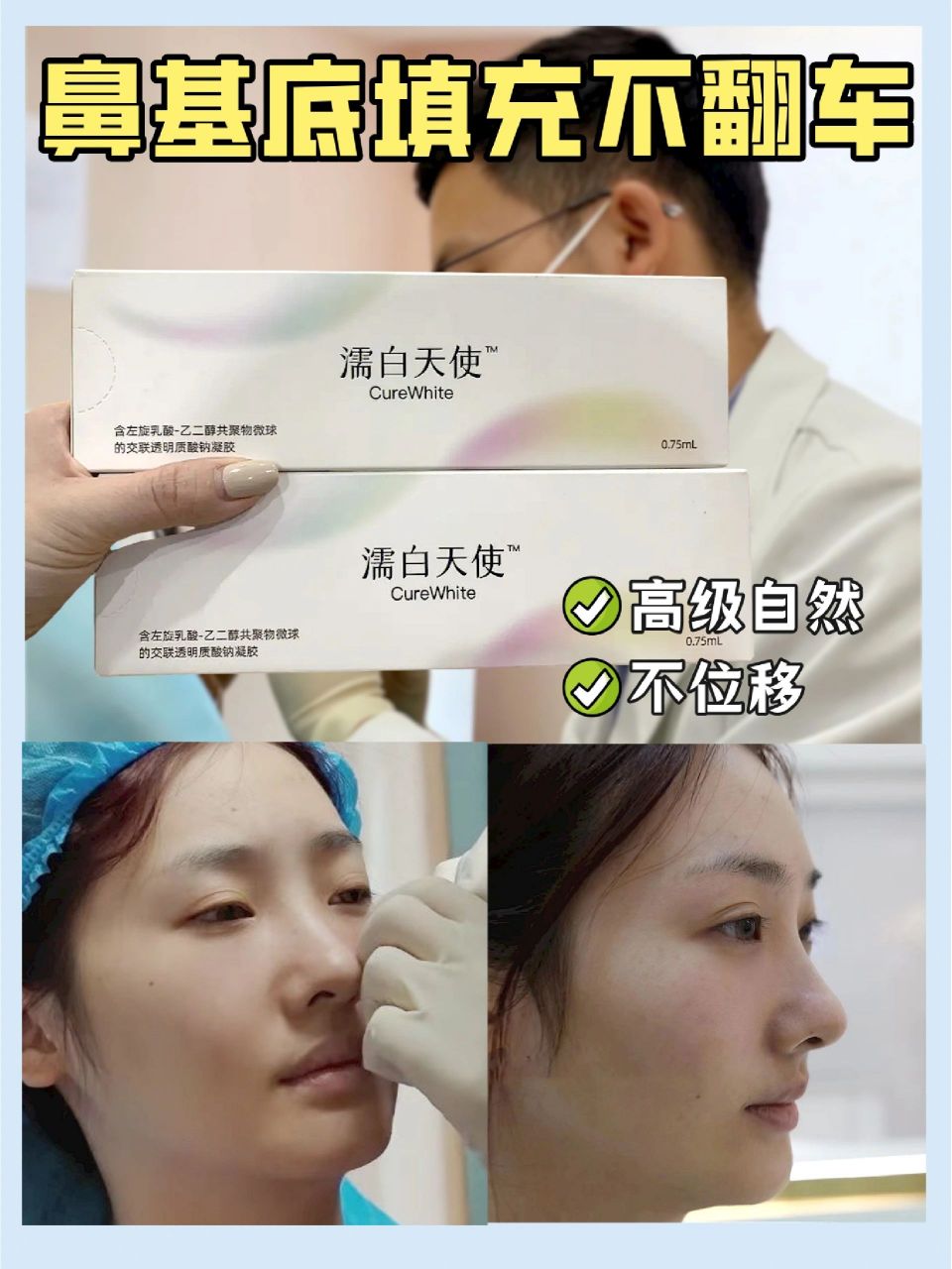 97点击页面下方【立即咨询】,回复【城市】,获取本地鼻基底填充