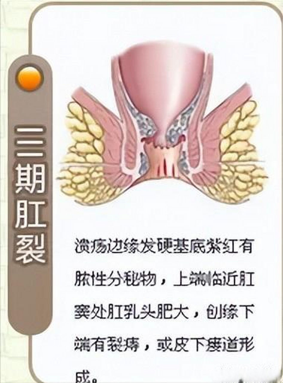 肛裂的症状图片 正常图片