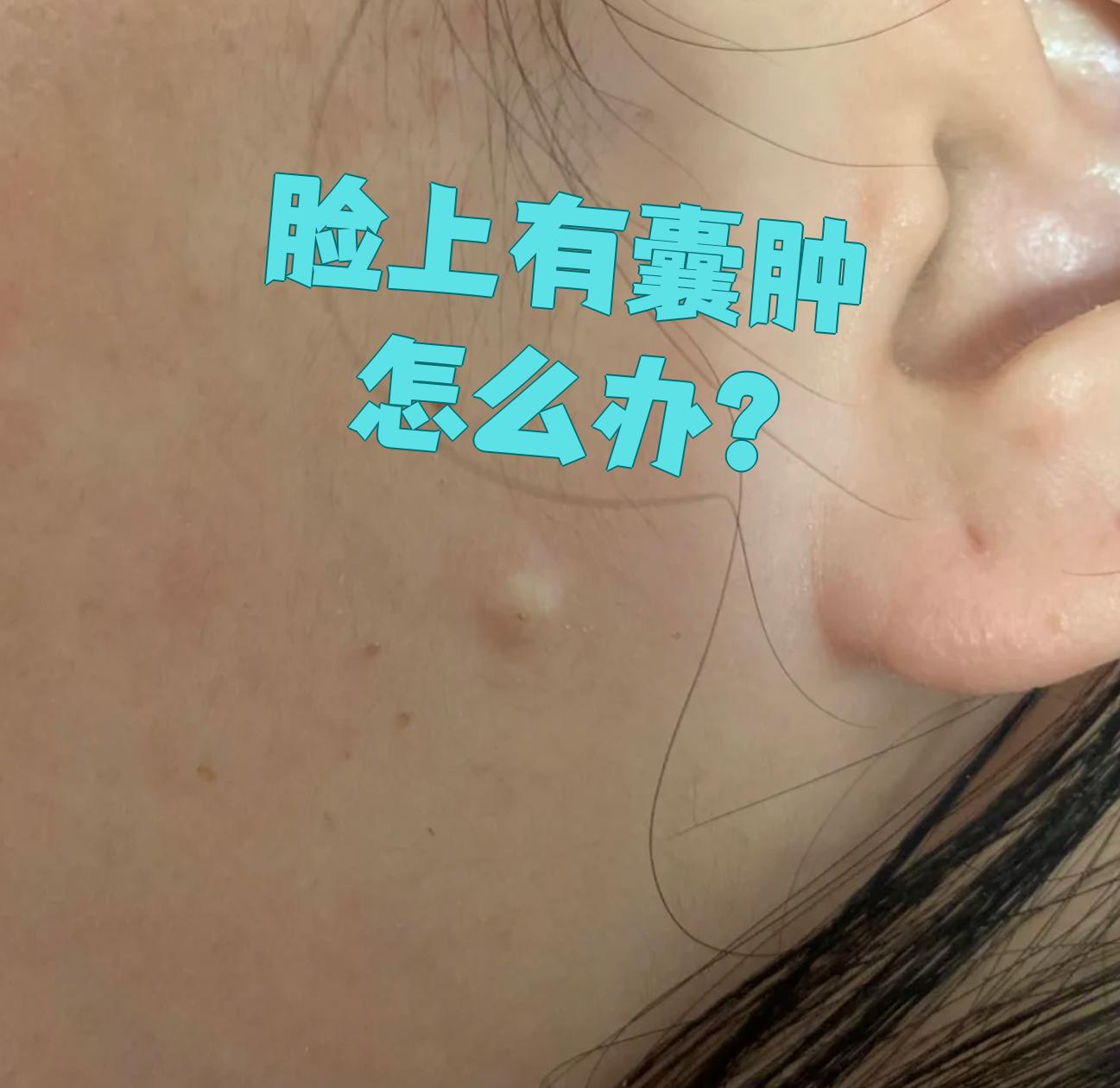 脸上长囊肿最常见的是表皮囊肿,治疗可以选择激光或手术