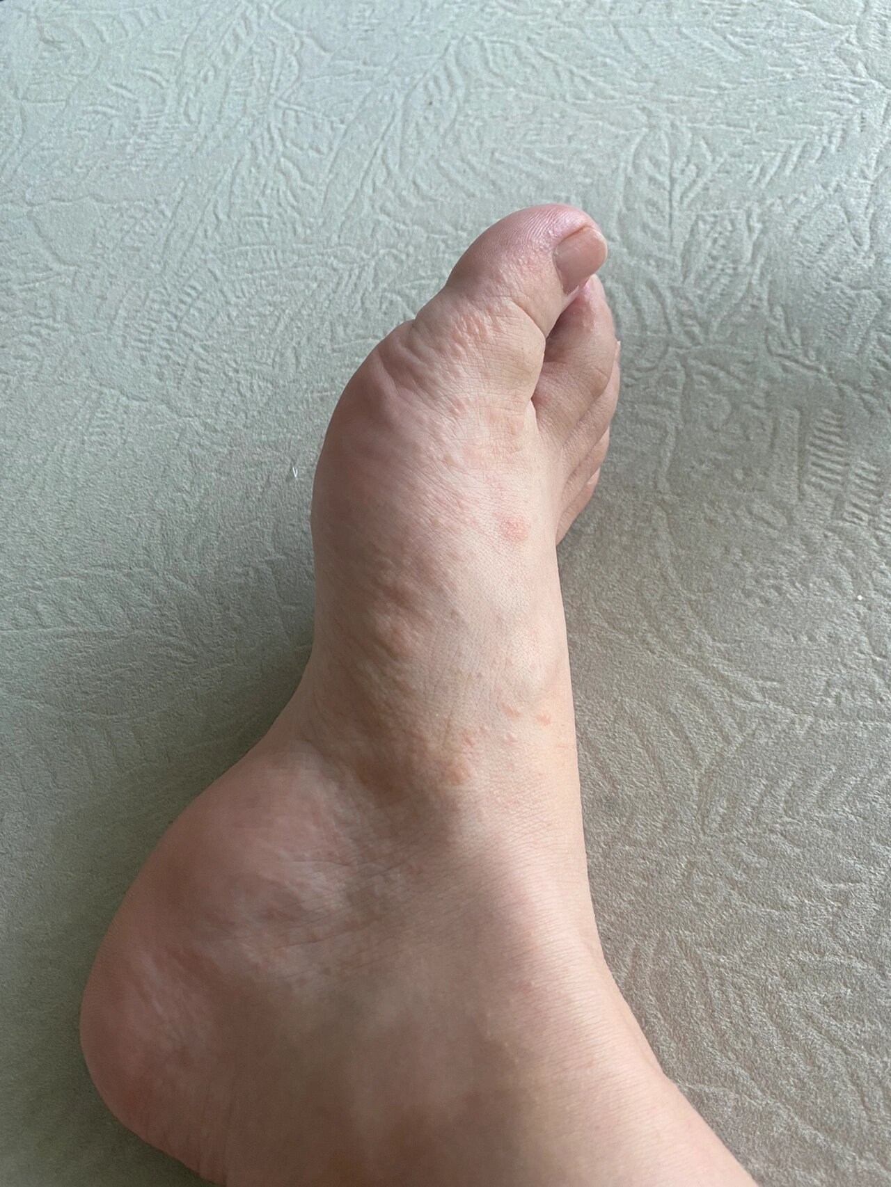 孕晚期休息在家突然爆发汗疱疹 奇痒无比 手脚爆发一层一层的疹子 痒