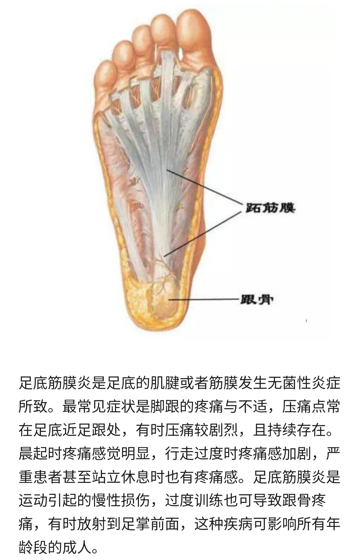 足底筋膜炎解剖图图片