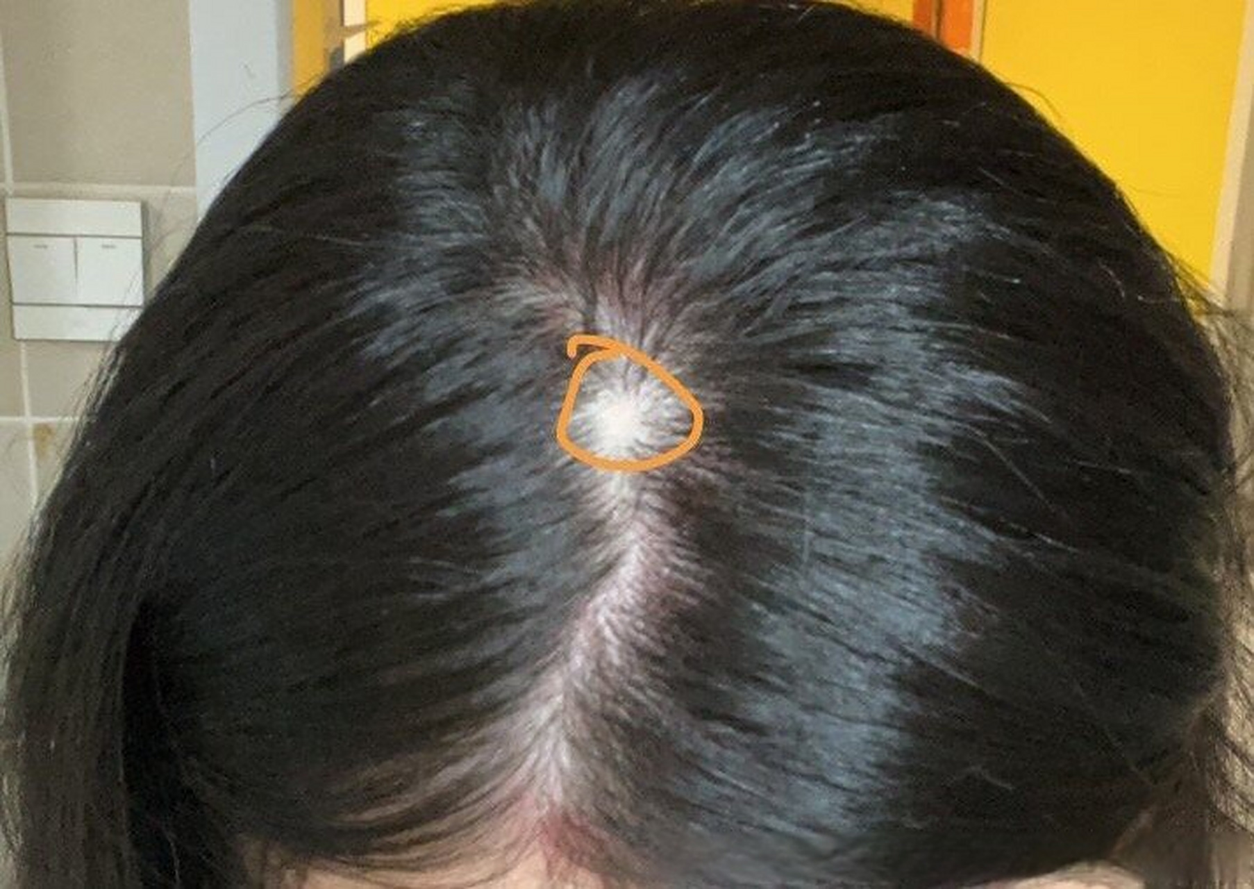 头上总有小疙瘩,一扣就有一大块头皮,经常扣破,病史大概有10年,断断续