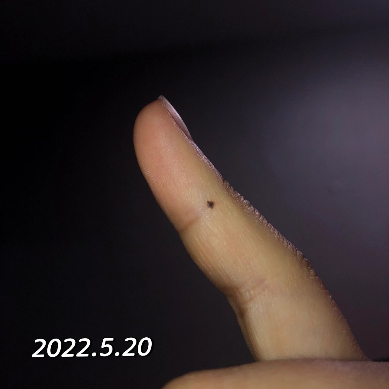 真的会长痣啊 右手手指头侧面长了个痣,看着它越来越清晰 用手打字就