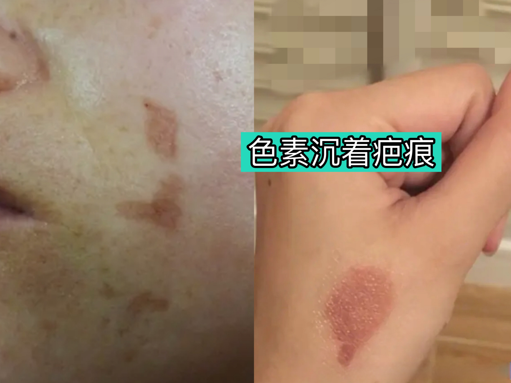 【做好防曬遠離色素沉著疤痕】 無論是激光祛疤後的新生皮膚,或是激光