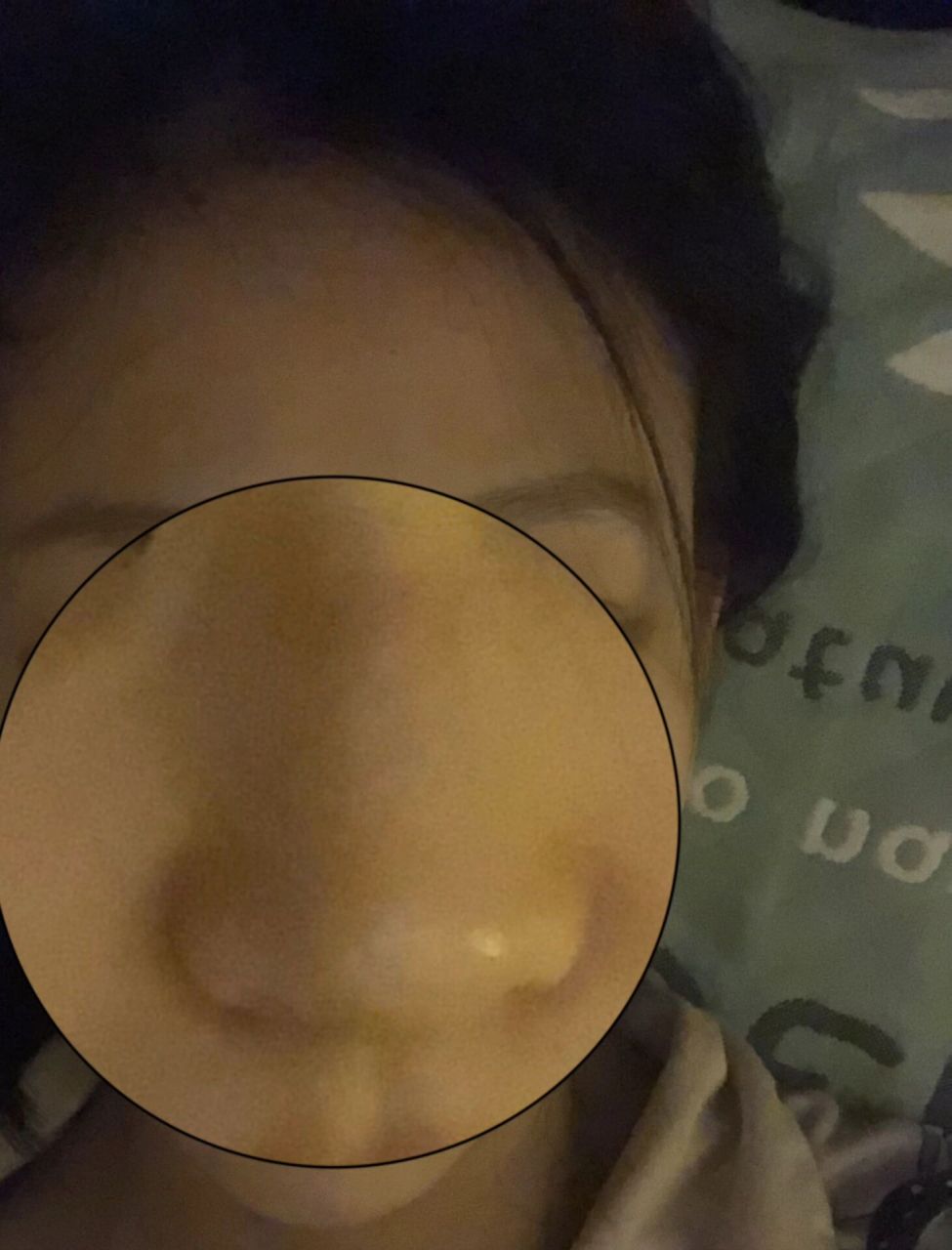 为什么鼻子上会有道红印啊 我妈妈说可能是口罩戴的,但感觉不像呢,摸