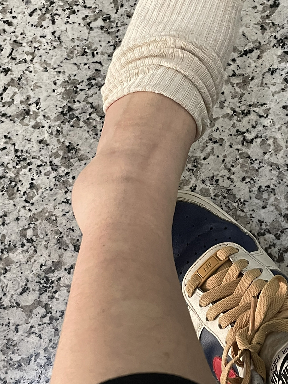 脚崴了半个多月现在还在紫青该怎么办啊 11.