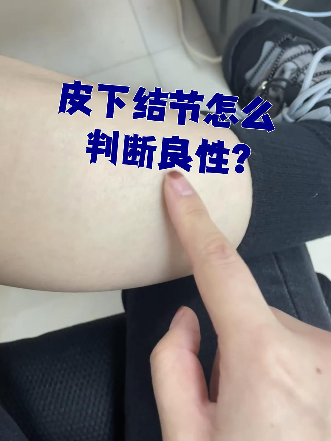 判断皮下结节是不是良性,主要靠这几种检查:体格检查,实验室检查