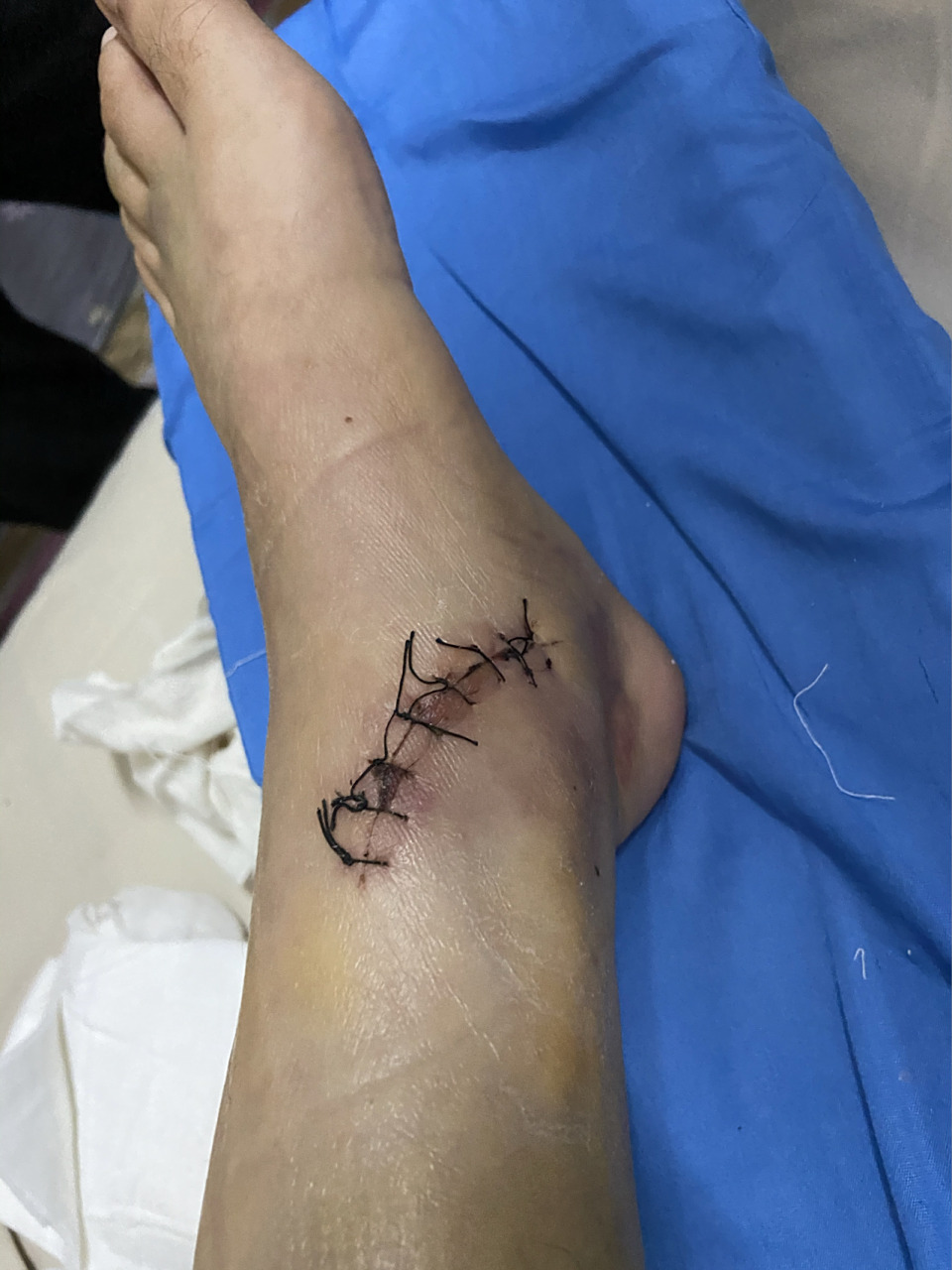 脚踝骨折之换药拆线篇 手术后的第八天,今天终于敢看下我的伤口了,没