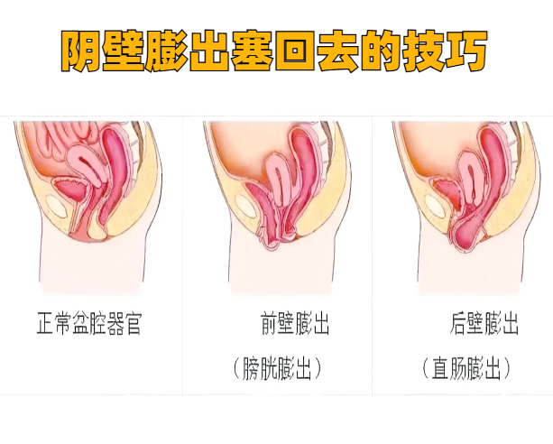 阴道前后壁膨出通过手术通常能完全治好,但一定要去正规医院检查