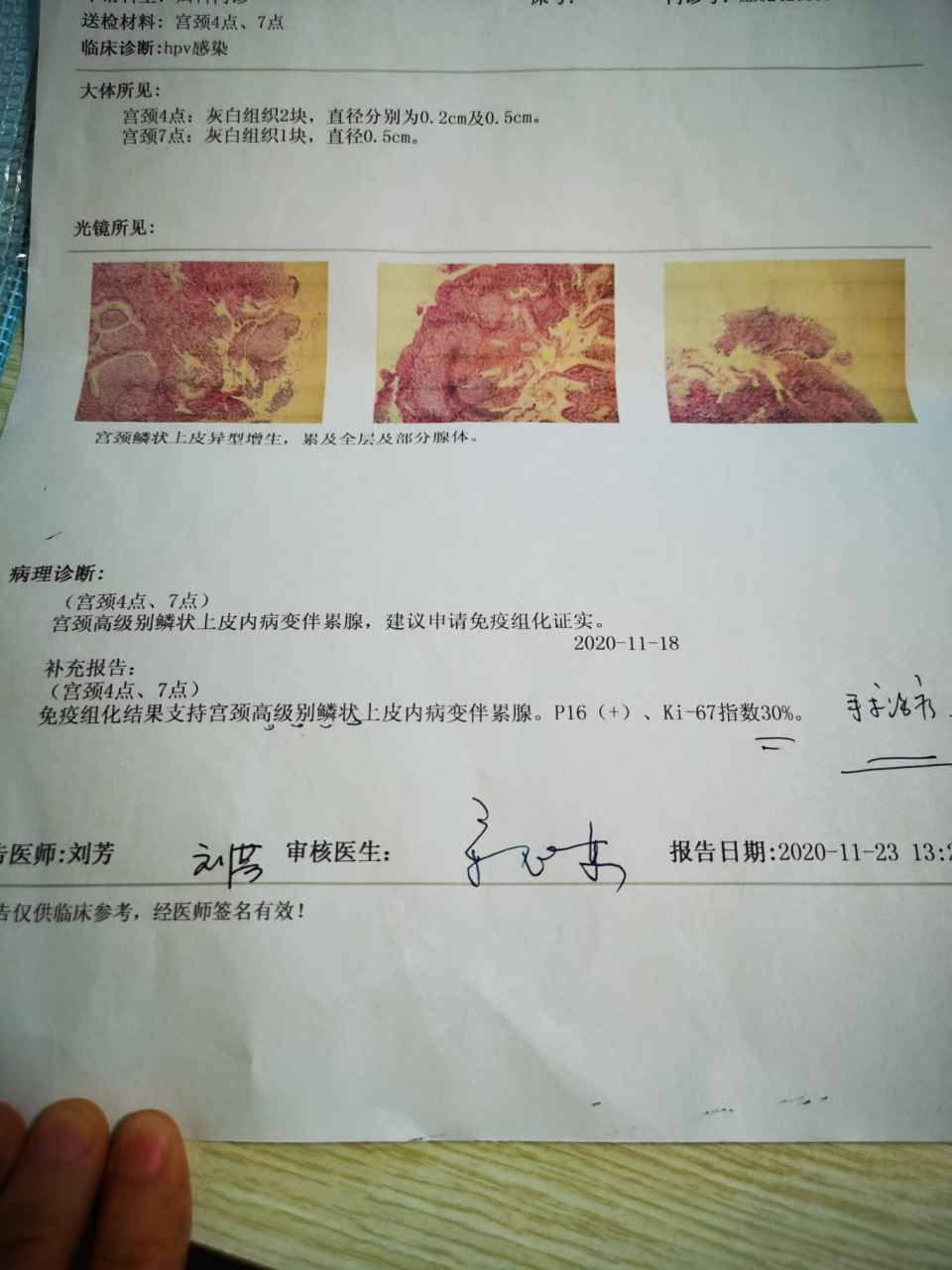 宫颈高度病变,cin3级,锥切还是保守治疗?