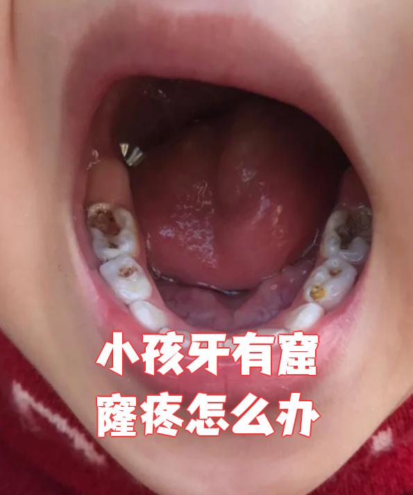 孩子牙齿有窟窿还疼,要马上去医院口腔科看
