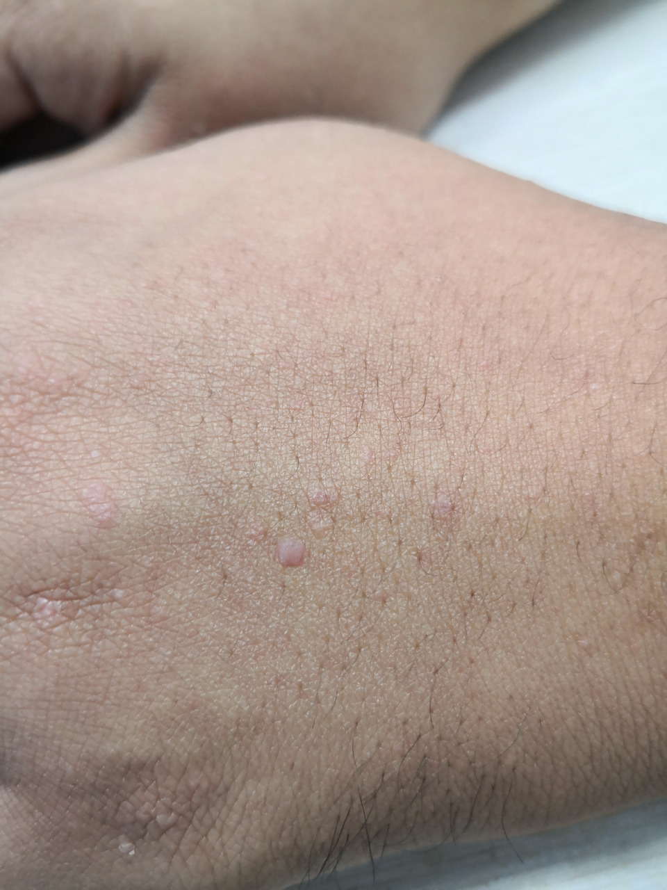 手背扁平疣症状#扁平疣##病毒