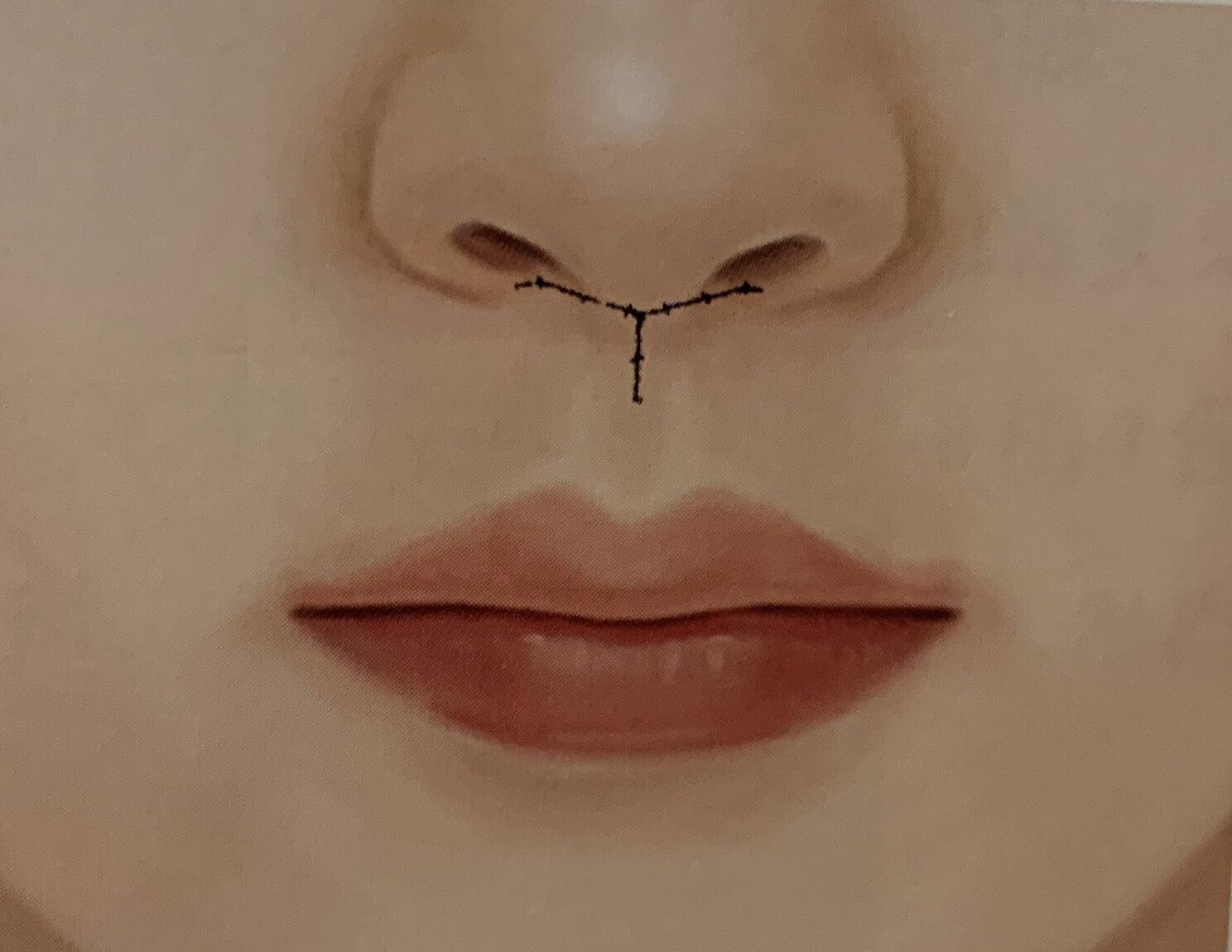 人中延长示意图 人中延长手术设计原理: 沿鼻小柱,双侧鼻槛,双侧鼻翼