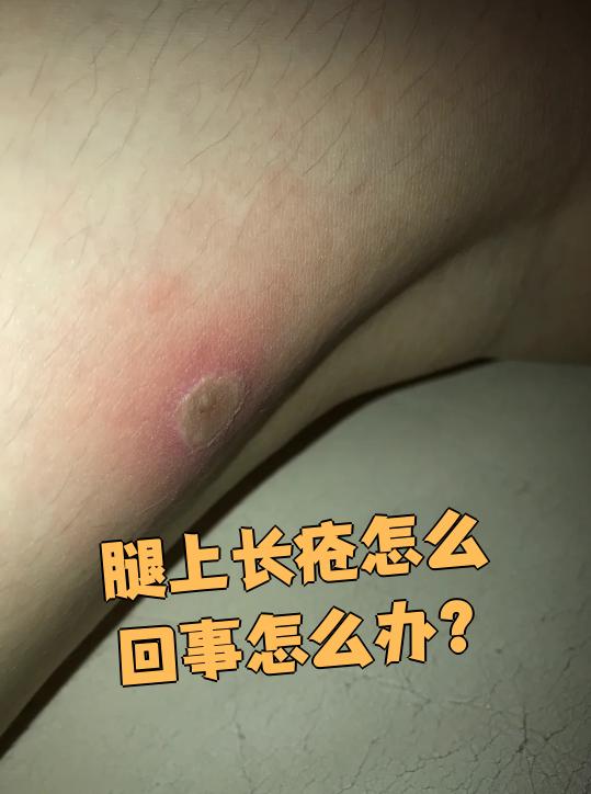 腿上长疮常见原因包括外伤和小腿溃疡