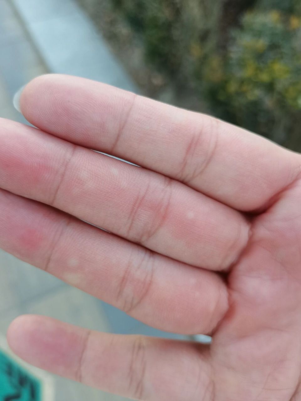 手心起白色疙瘩是因为什么 第一次起 不到半小时就没有了 有点痛