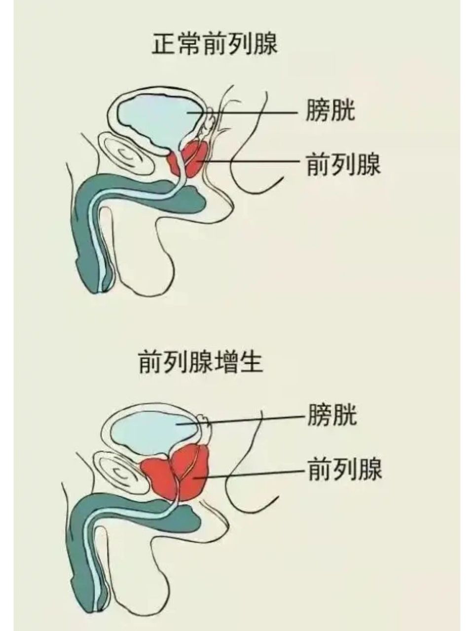 前列腺钙化是很多患者在体检或者做其他相关检测的时候,发现的一个