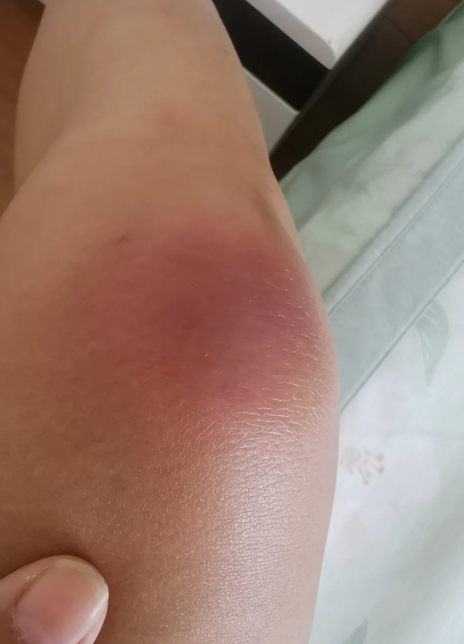 痛风刚开始发作时,最常见的症状就是关节突然红肿,剧烈疼痛,还经常