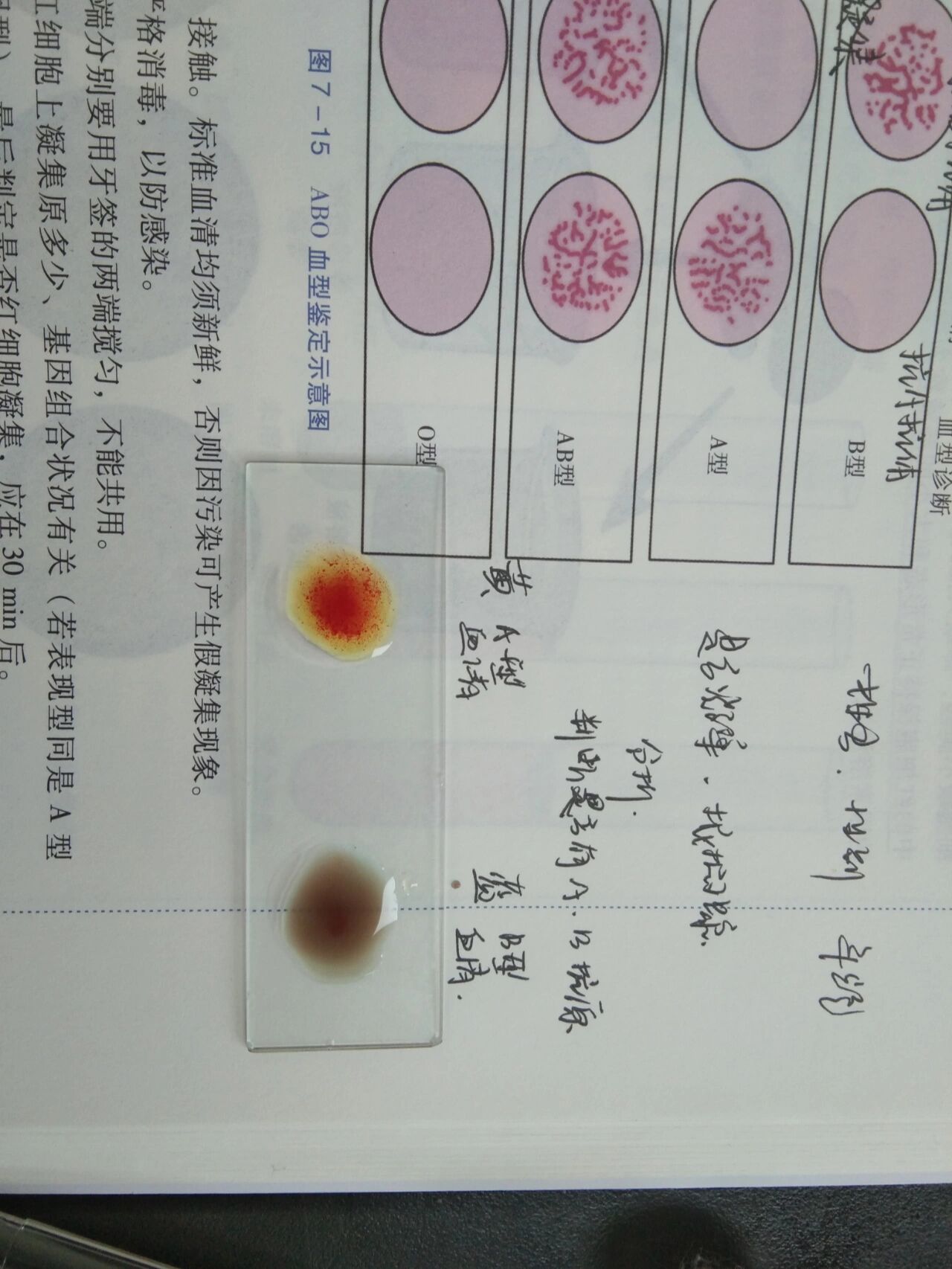 abo血型鉴定,b型