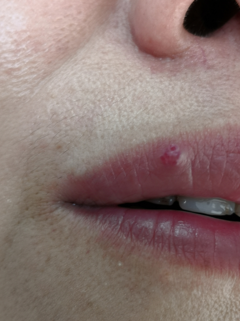 唇红部位的红色增生物.