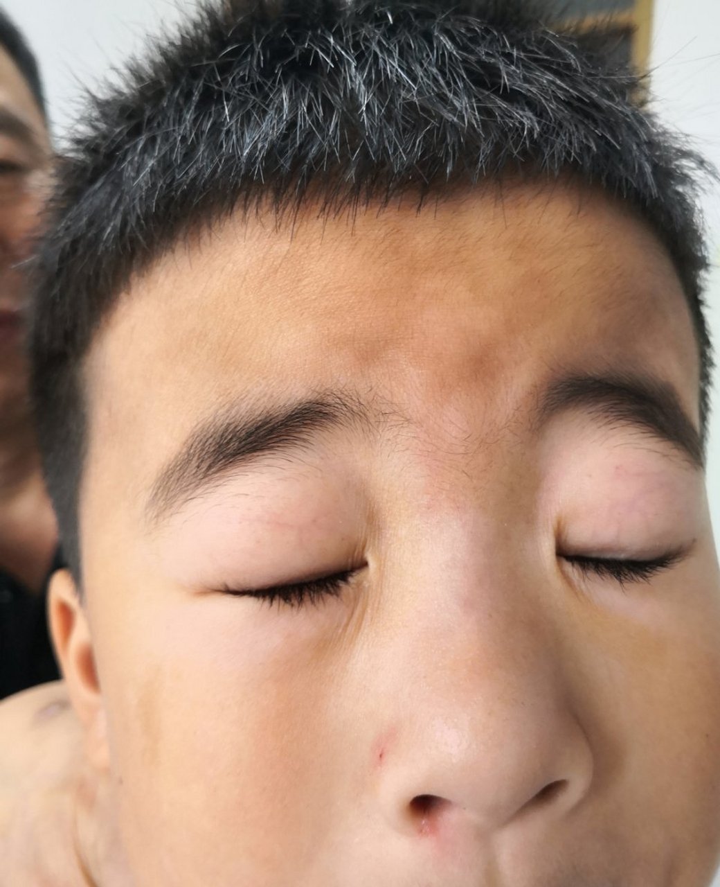 有特应性皮炎的诊断.考虑单纯糠疹.