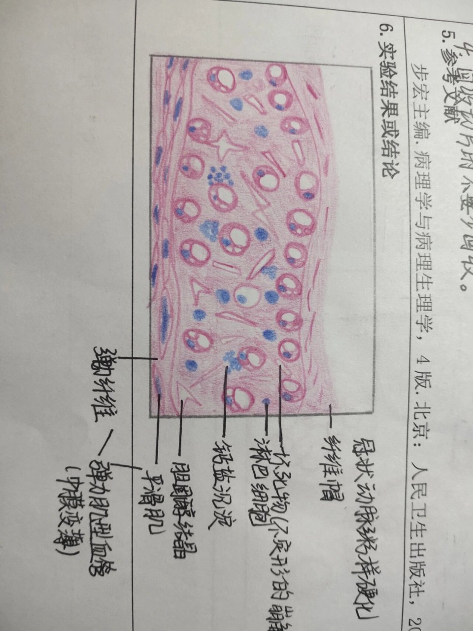 动脉粥样硬化红蓝铅笔图片