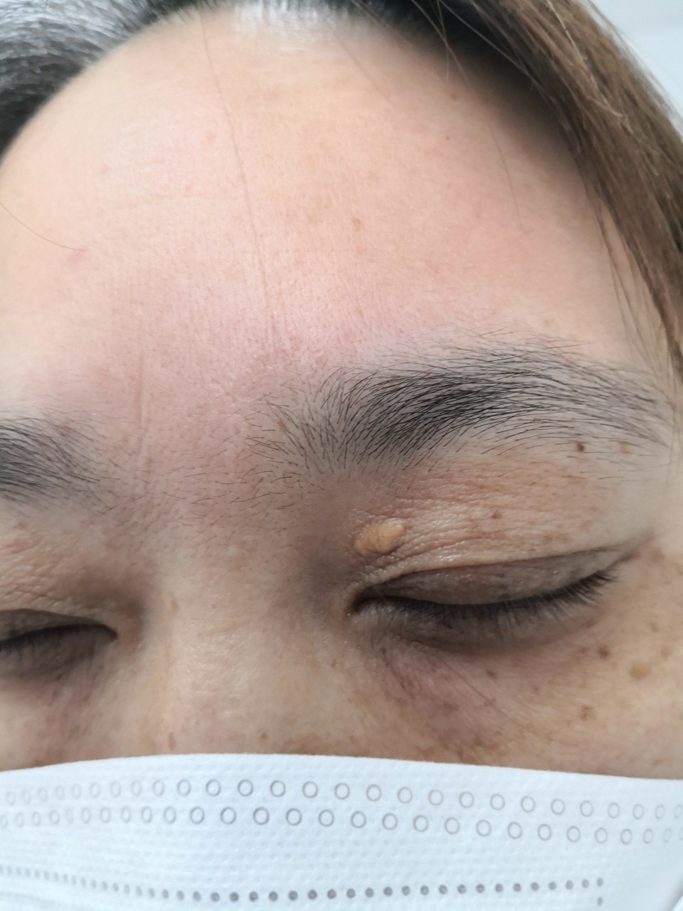 眼睑睑黄疣.#睑黄瘤# 要排查一下高血脂#美容# 可以使用激光治疗去除.