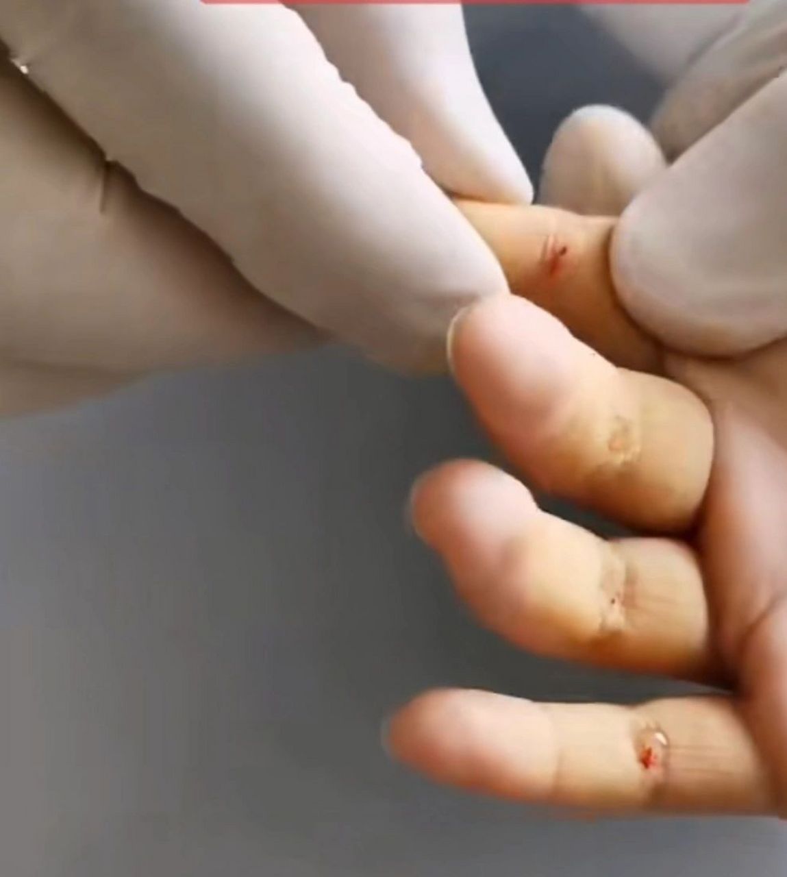 走投无路了——扎四缝穴(一) 发自内心的建议天下所有为人父母或者