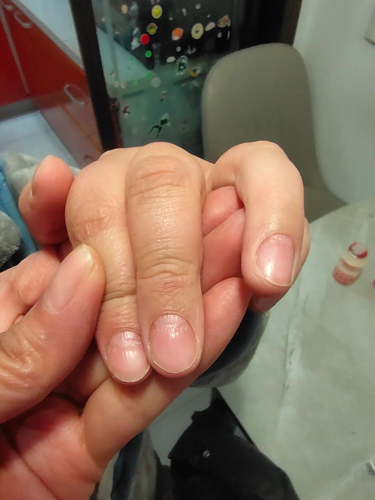 孩子每个指甲出现凹陷是怎么回事?