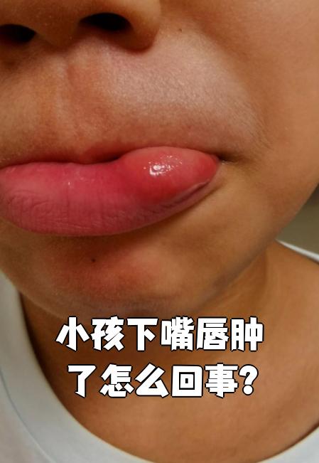 为什么嘴唇会肿起来