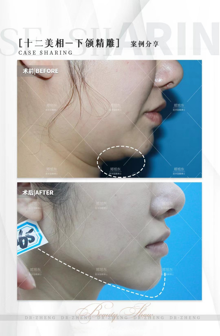 十二美相 —— 下颌精雕 下颌在面相十二宫中排位第九;美学上强调立体