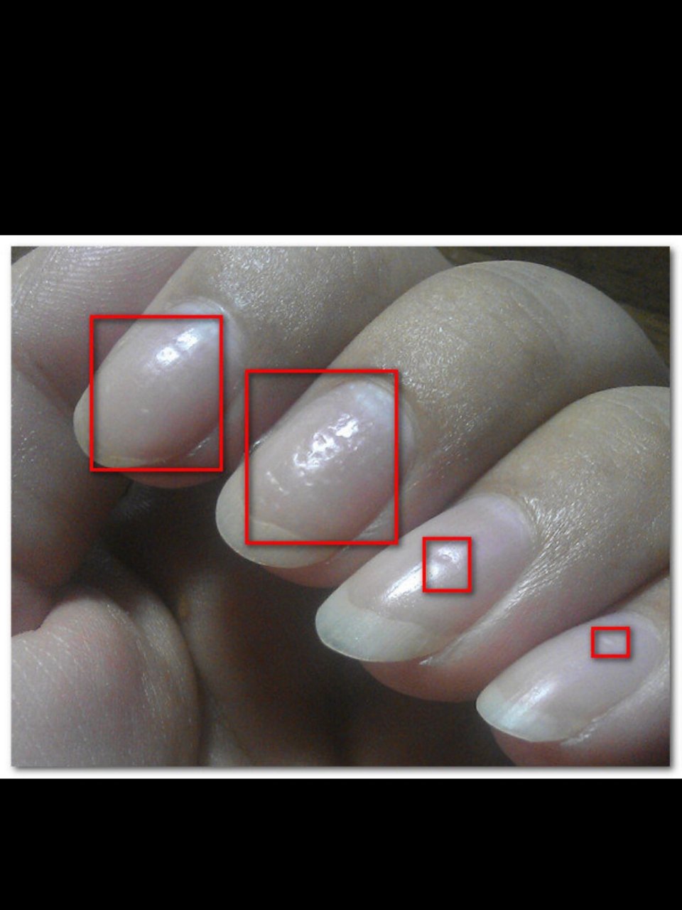 指甲有凹陷是什么原因图片