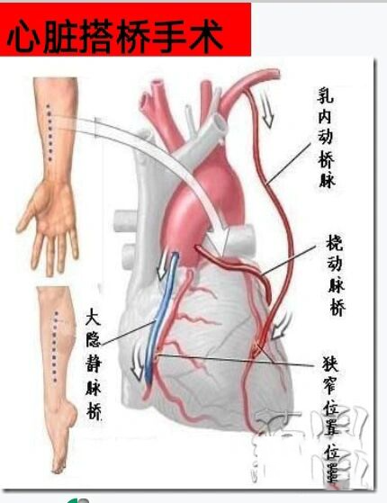 心脏搭桥手术你了解吗?