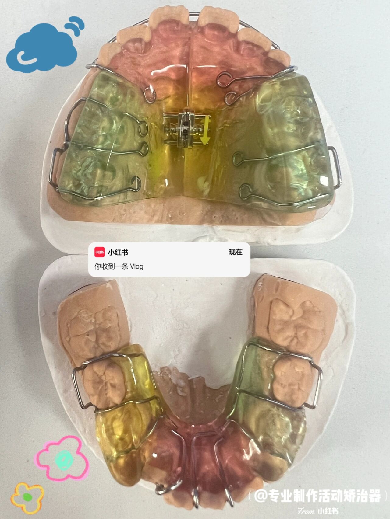 下颌后缩矫正—双颌矫治器(twin-block)75