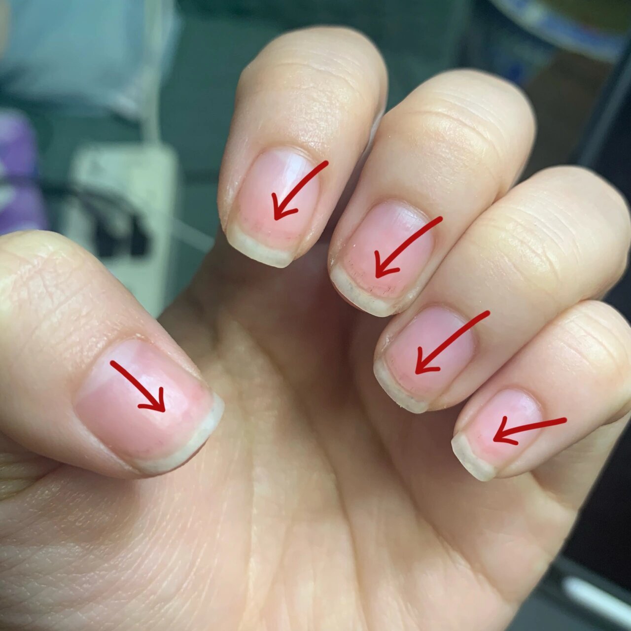 卸甲后甲面受损有红血丝还疼 本月16号卸的美甲然后也是第一次做美甲