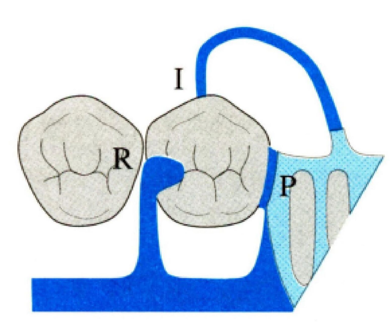 rpi卡环组受力分析 可摘局部义齿(2) p1<rpi卡环组模式图及受力