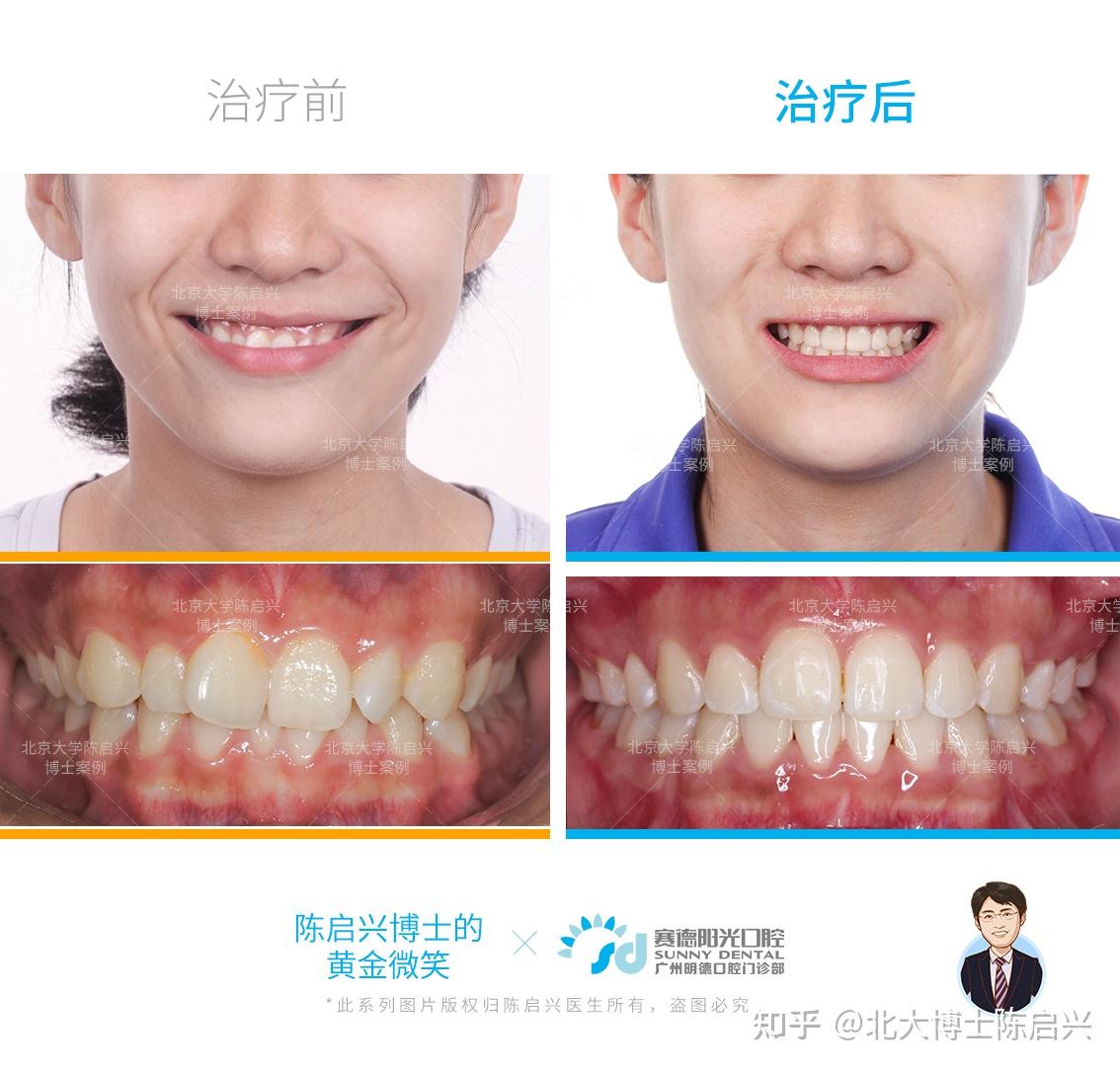 牙齿拥挤门牙扭转深覆合露龈笑矫正案例