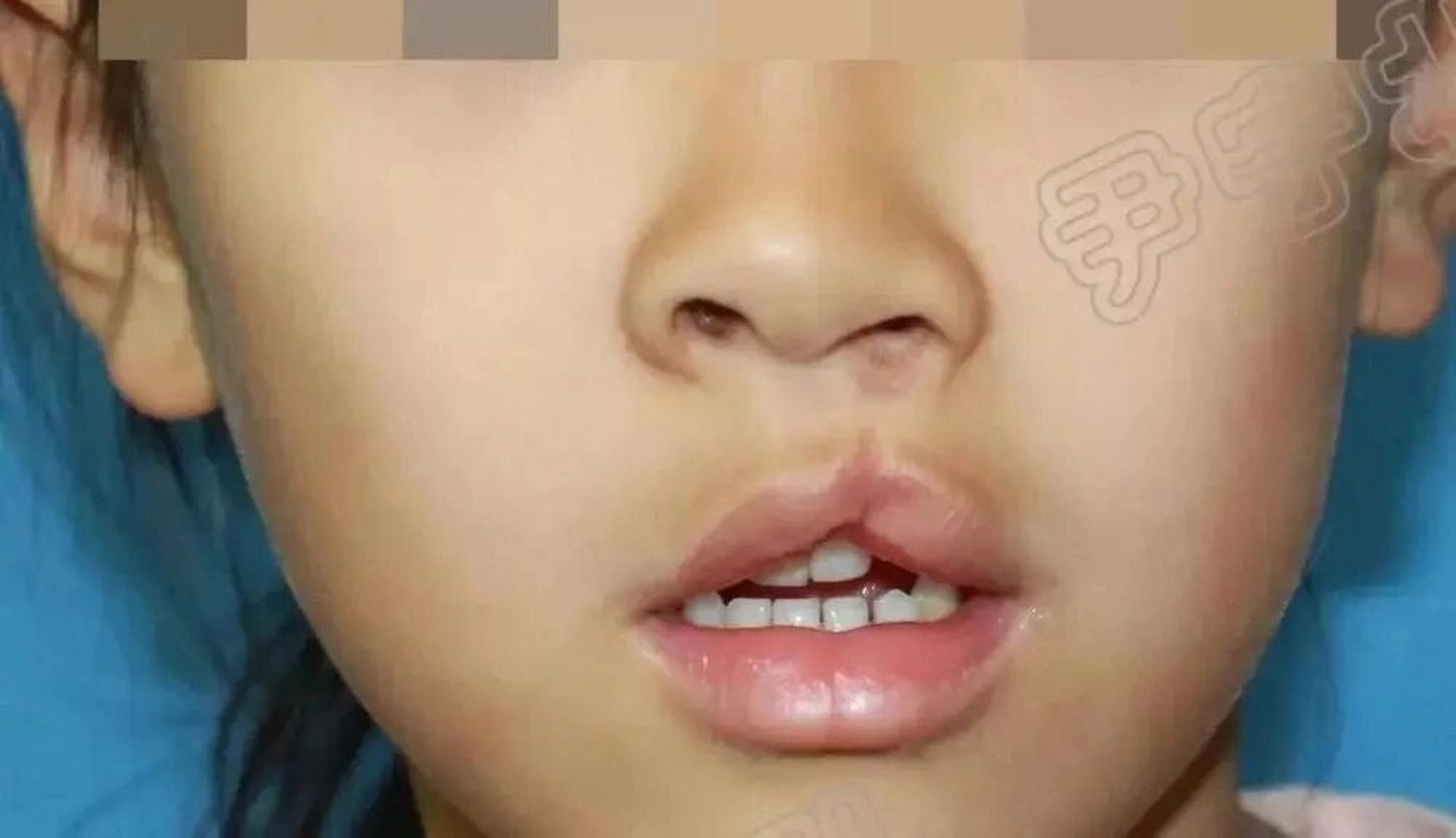 也正是由于理论的缺位,导致全行业内对隐性唇裂的治疗理念和基本手术