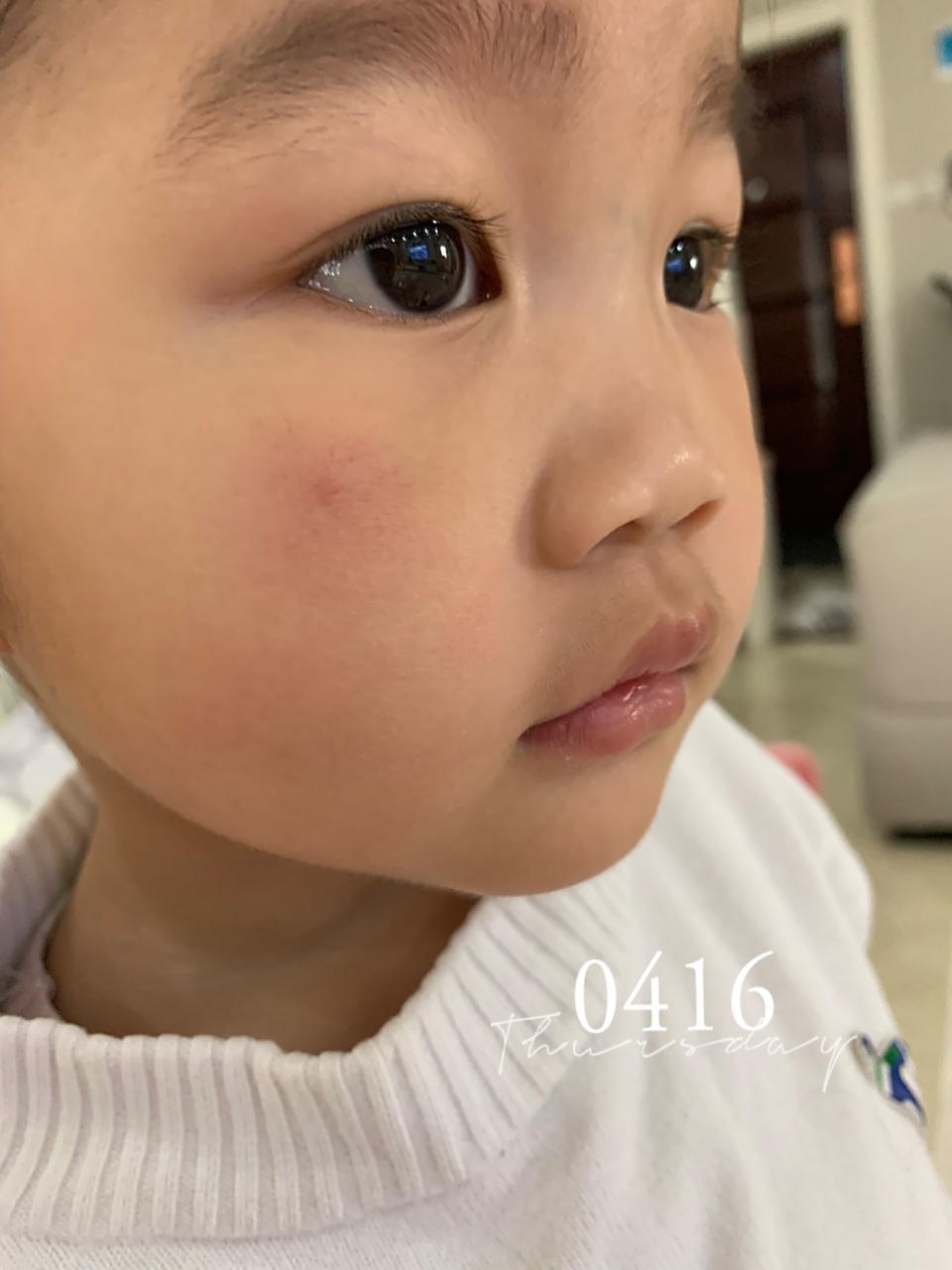 儿童蜘蛛痣 刚解决完便秘 脸上蜘蛛痣又来了01 老母亲太累了09