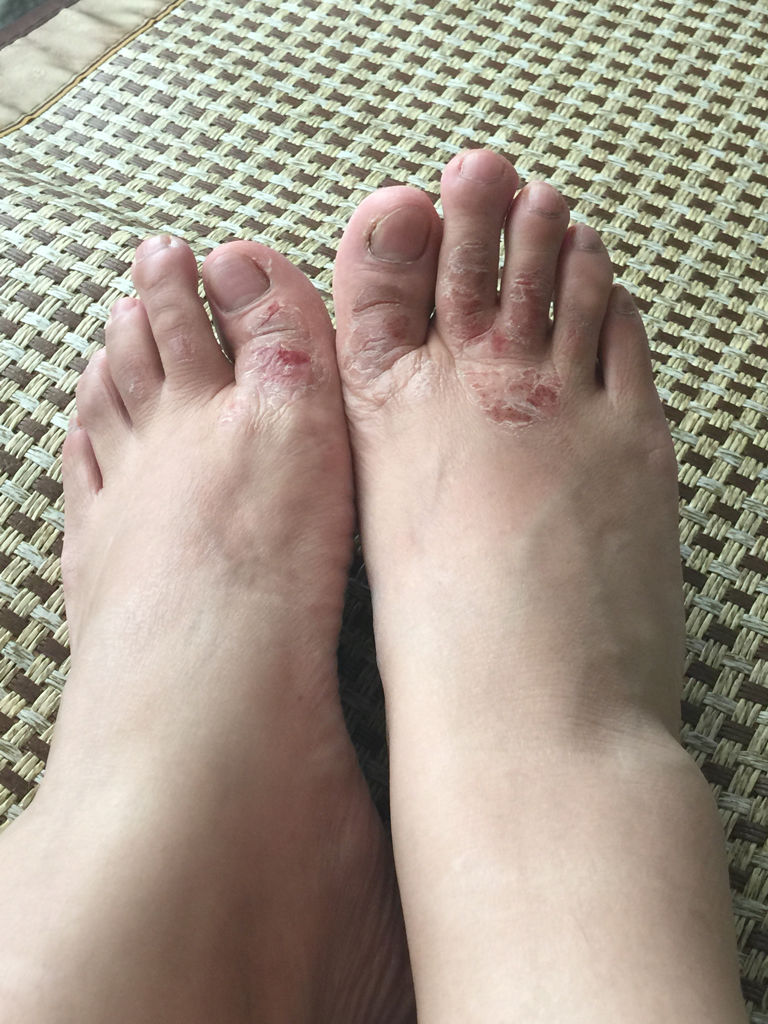 顽固性脚气10年了烂脚丫脱皮瘙痒有异味夏天不敢脱祙子还有救吗