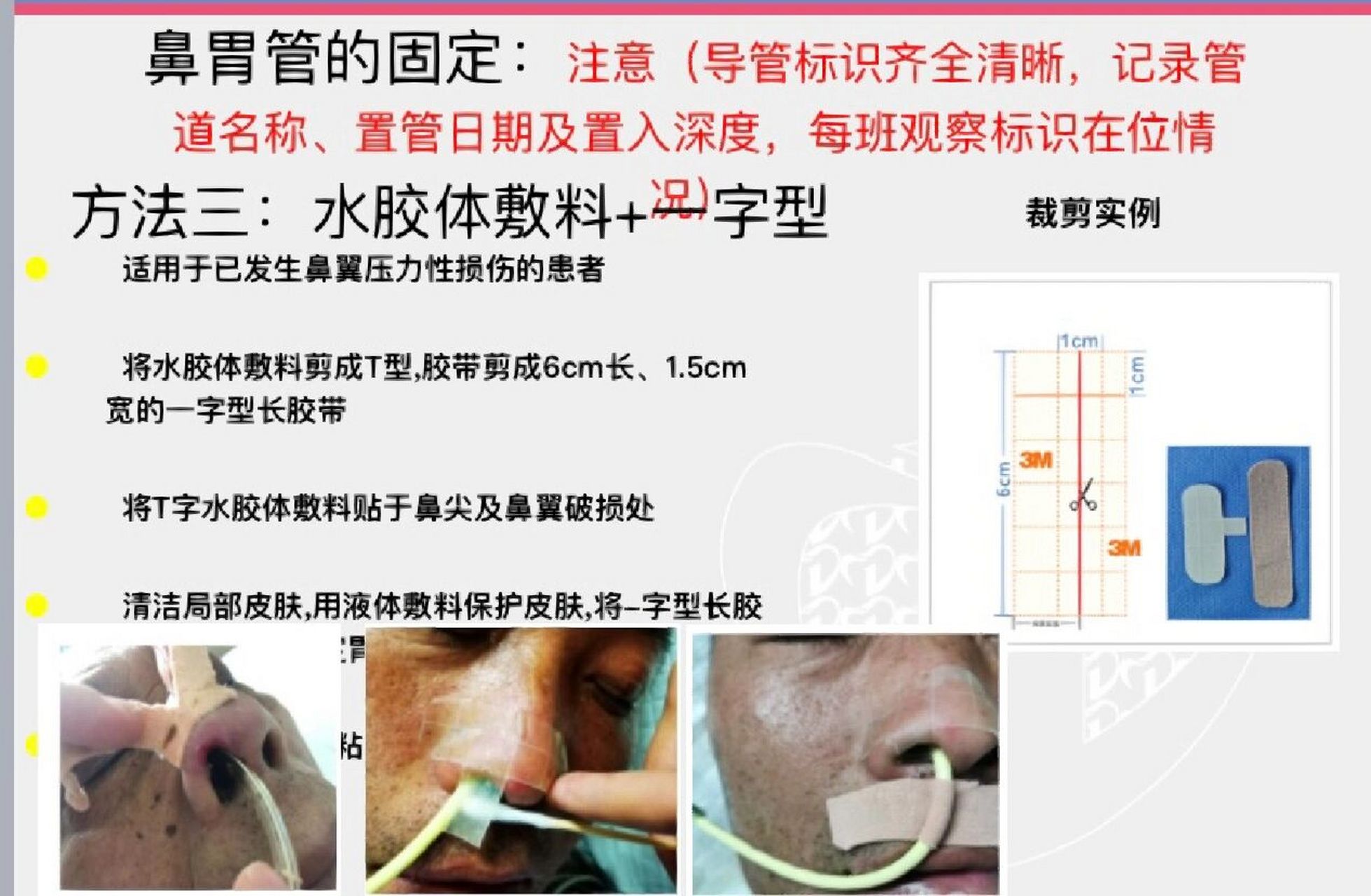 胃管双耳挂绳固定方法图片