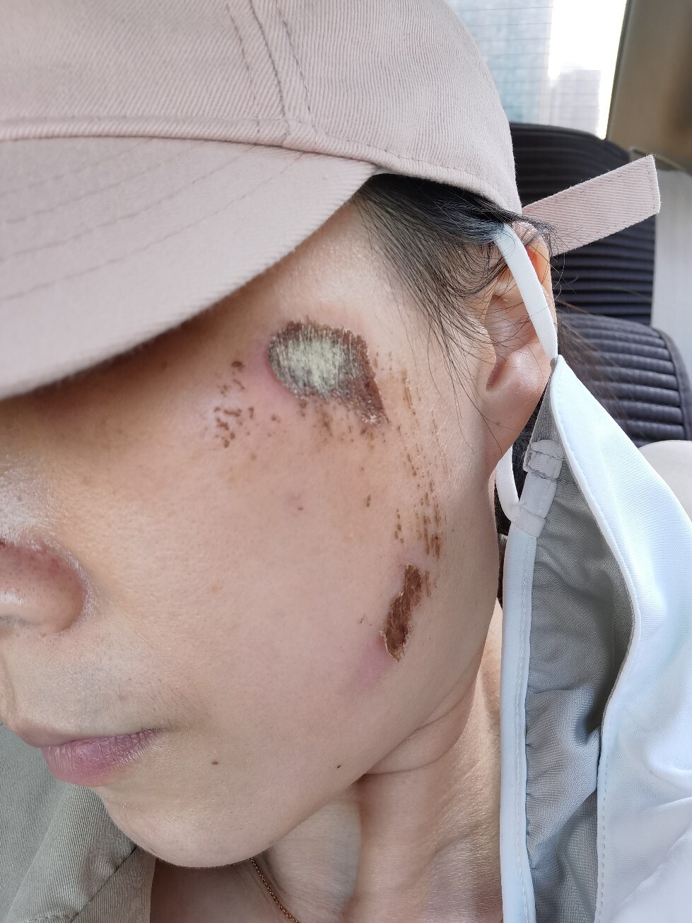 脸部擦伤后的恢复