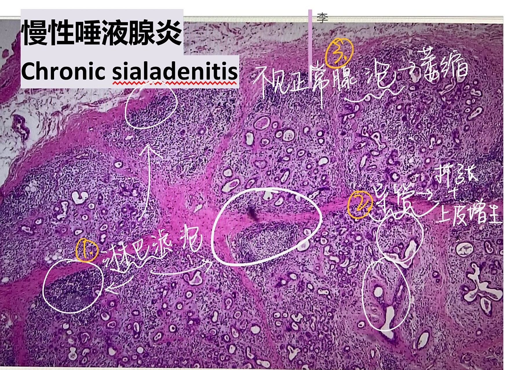 慢性唾液腺炎77舍格伦综合征 病理组织切片 唾液腺疾病 口腔组织