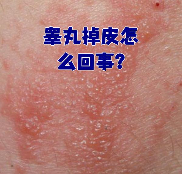 睾丸掉皮可能由多种原因引起,包括生理因素,阴囊皮炎,阴囊湿疹和核