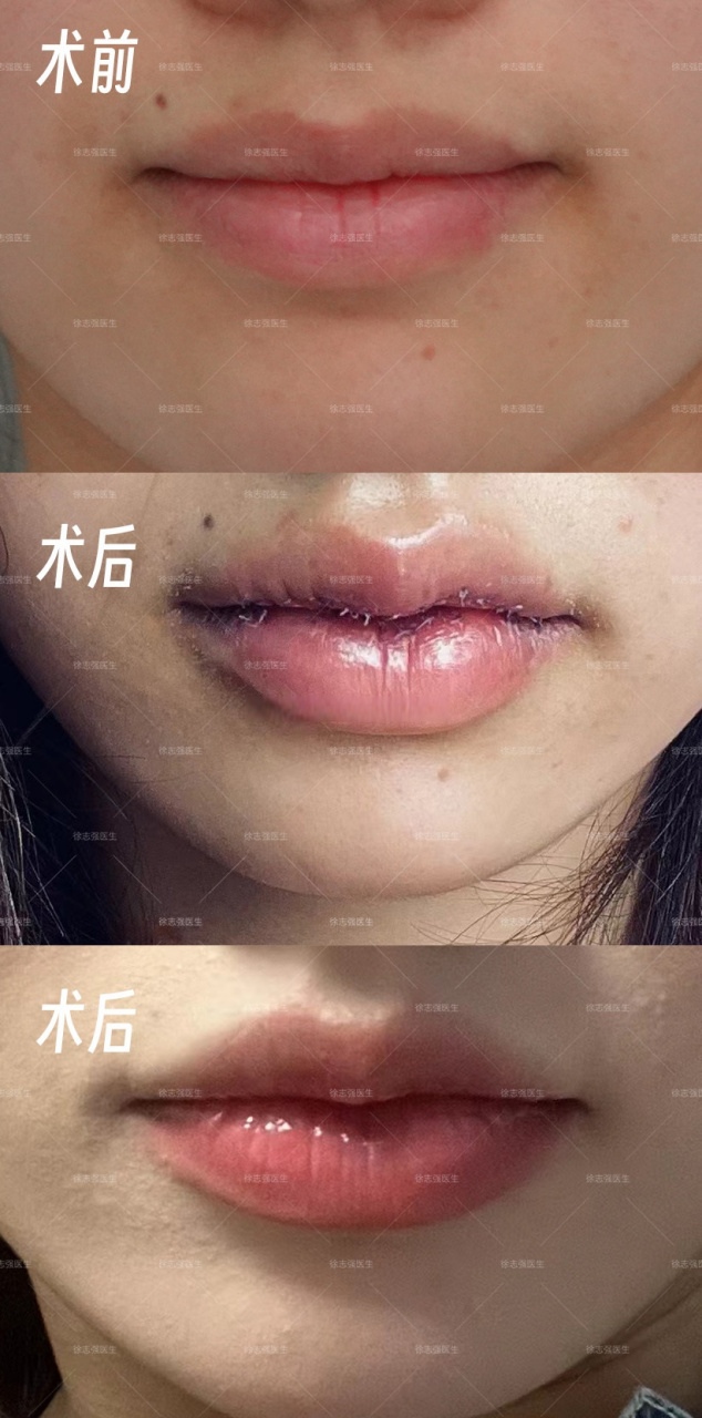 上下唇唇型矫正术后一个月#徐志强医生案例#m唇