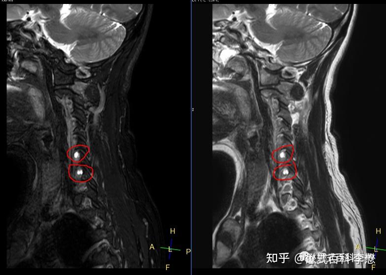 磁共振上显示神经根袖囊肿是什么意思