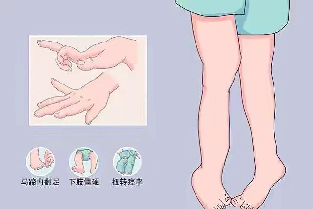 婴儿期多表现为肌张力低下 肌张力低下突出表现是竖颈发育明显延迟