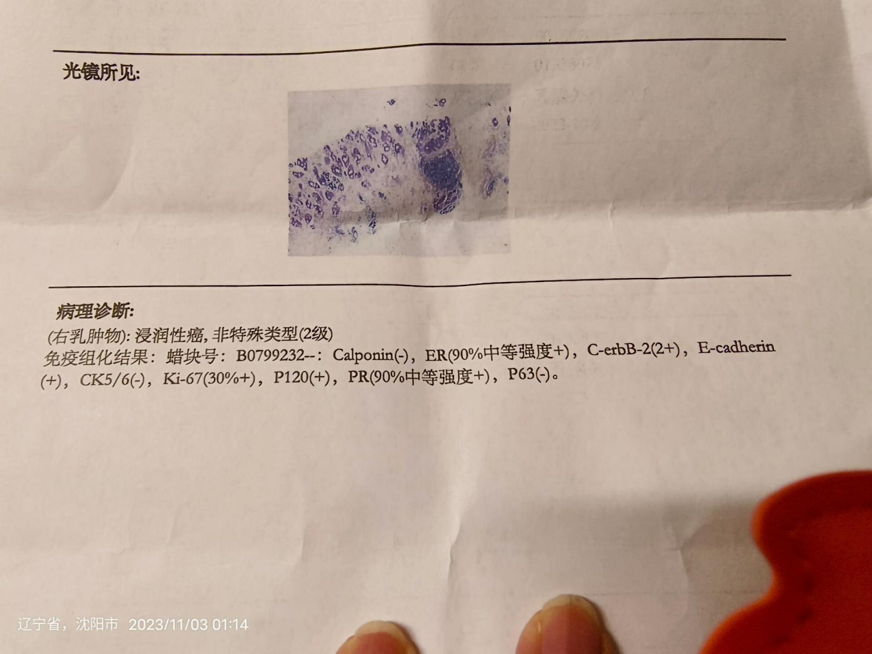 乳腺癌 非特殊型侵润性导管癌二级   周四拿到病理报告,预料到,又没